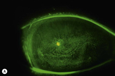 Eye suffering from Persistant Epitherlial Defect